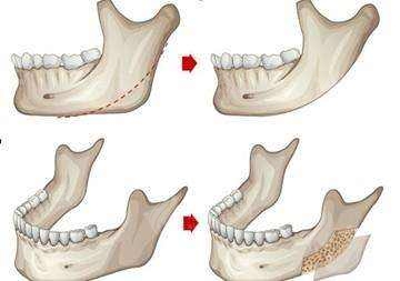 　　磨骨手术后不会留下疤痕，能有效改善各种脸型?
