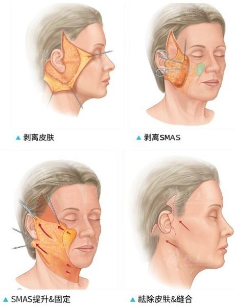 上海第九人民医院拉皮多少钱？紧肤除皱项目介绍及价格表