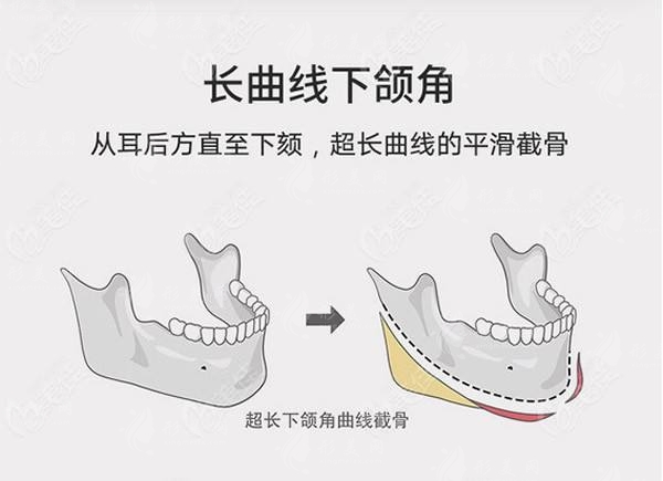 圣嘉新张笑天轮廓科普：下颌角手术磨骨好还是削骨好呢