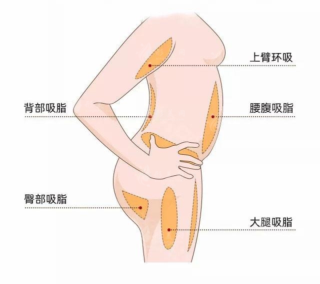 北京顾云鹏手臂吸脂手术费用多少钱？附新价格表