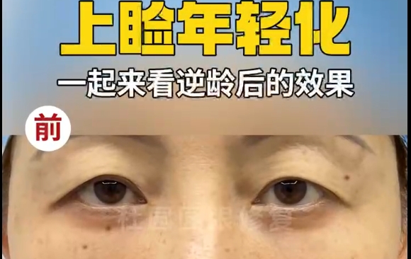 眼窝塌陷，上睑皮肤松弛？杜圆圆上睑年轻化一起来看看