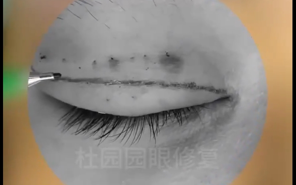 眼修复不祛皮，原疤痕怎么办？杜圆圆医生为你解答