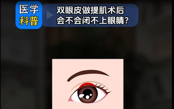 双眼皮做提肌术后真的会闭不上眼？专家杜圆圆解答 