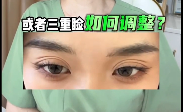 双眼皮术后多重睑困扰？杜圆圆医生揭秘调整技巧