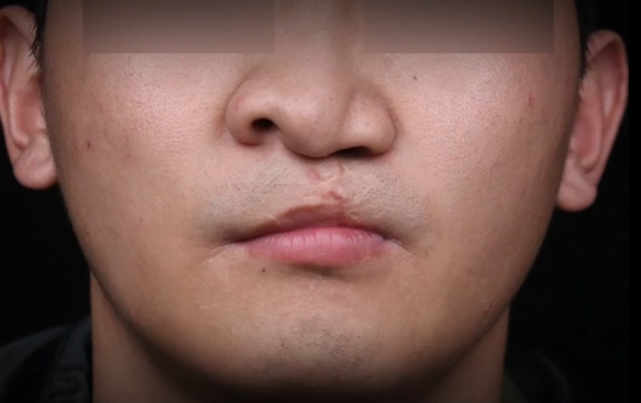 严重唇裂鼻，口鼻漏1.5cm怎么办？余文林医生带您揭秘