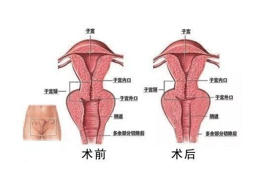 变性手术 子宫图片