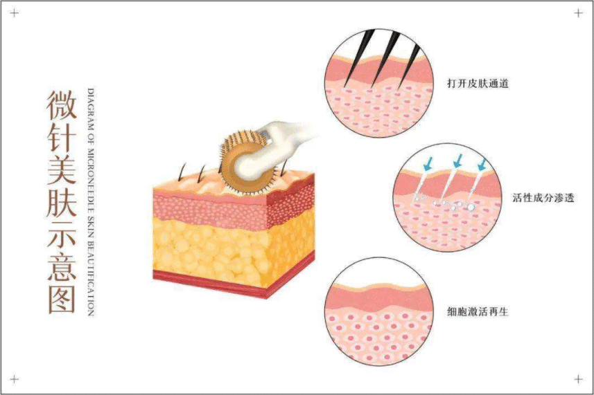 微针做一次的价格是多少?