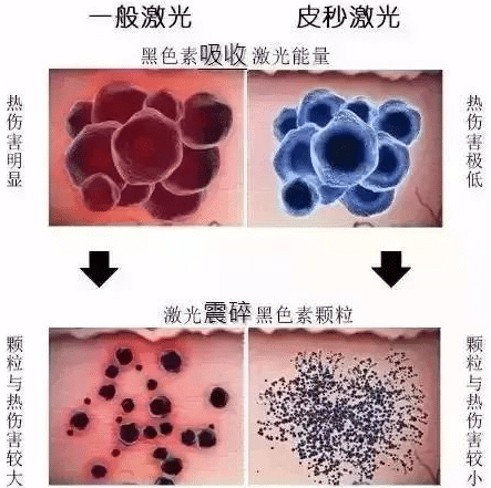 激光皮秒