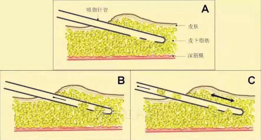 大腿抽脂