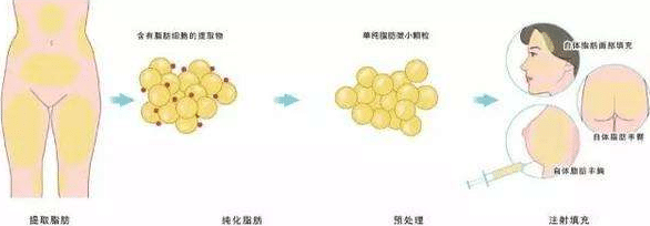 抽脂隆胸