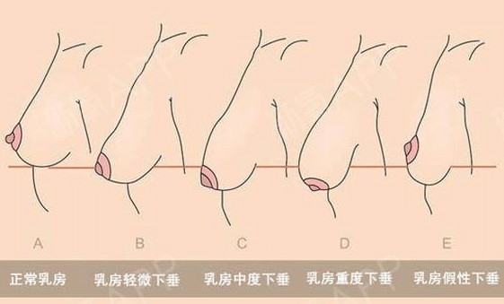 胸部下垂解析图