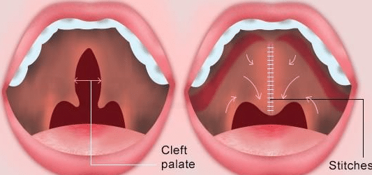 唇腭裂修复