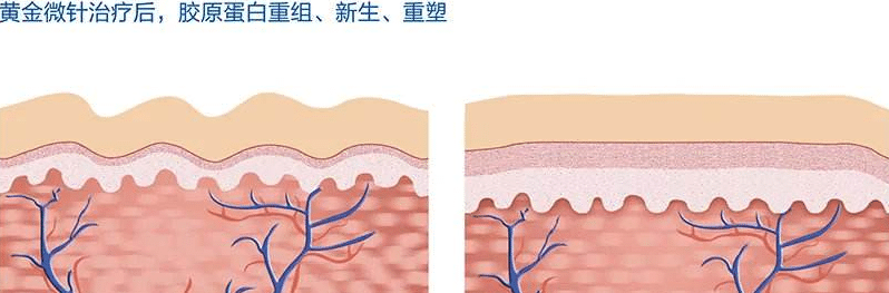 黄金微针