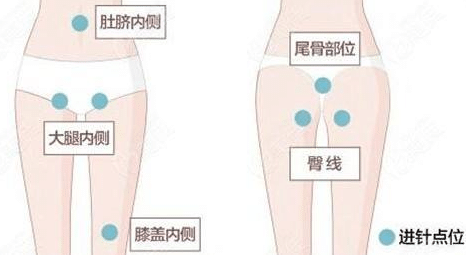 大腿吸脂过程