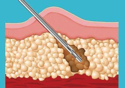 吸脂手术