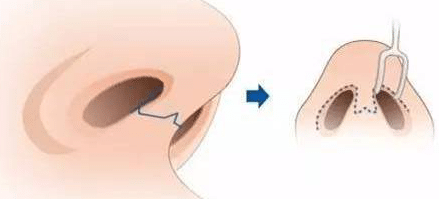 鼻翼缩小手术