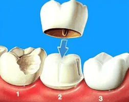 单颗修复牙齿