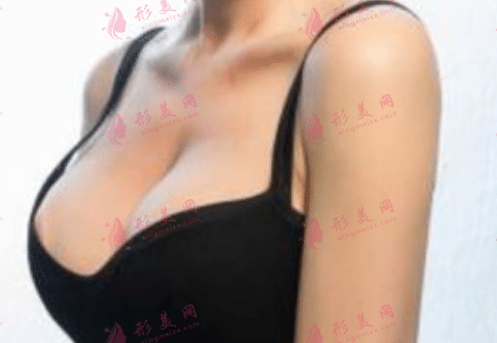 乳房下垂提升