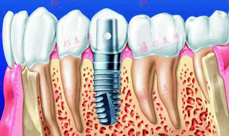种植牙打桩