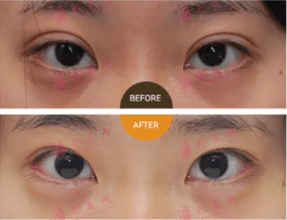 双眼皮失败修复方法有哪些?