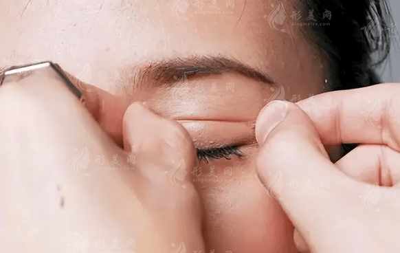 全国正规双眼皮医院已经帮你选好了，割双眼皮什么价位？
