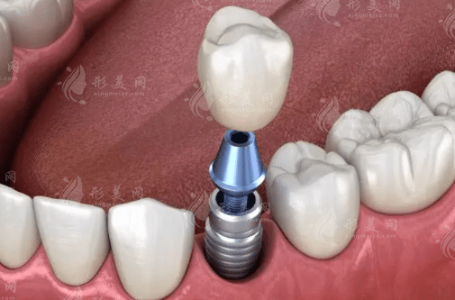 宁波种植牙多少钱一颗