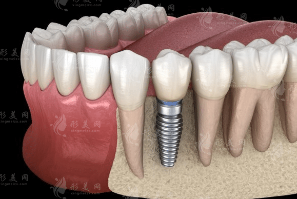 种一颗牙大概需要多少钱2023，国产进口种植体收费价格