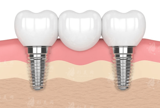 种一颗牙大概需要多少钱2023，国产进口种植体收费价格