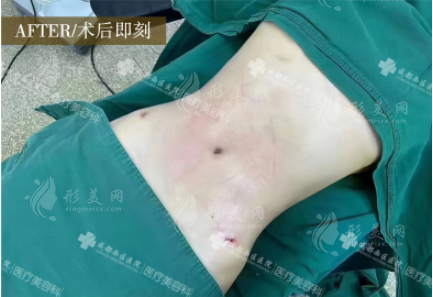 成都西区宋华敬腰腹吸脂怎么样？顾客真实评价！