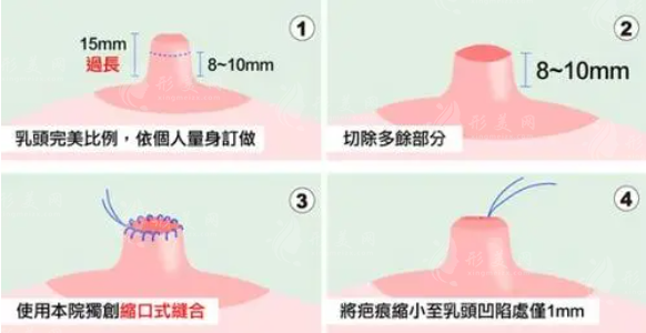 乳头缩小