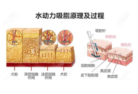 水动力吸脂和紧肤美容手术哪个好？一起来看看吧