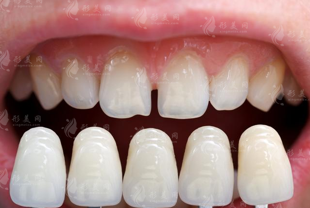 美容冠矫正牙齿的步骤如何？初步评估和诊断、维护和保养…