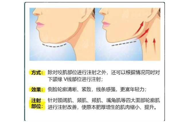 下颌缘提升多久打一次？效果能维持多久？