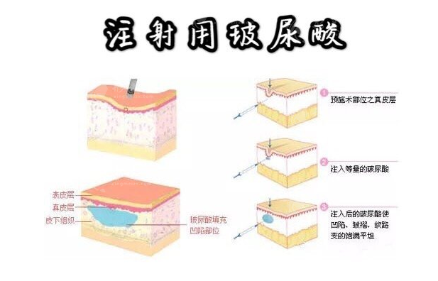 芙妮薇玻尿酸多少钱一支？效果能维持多久？