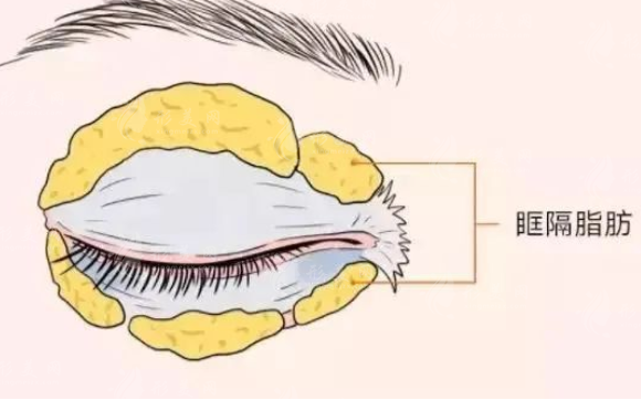 上眼皮抽脂怎么做？下面是上眼皮抽脂的详细介绍