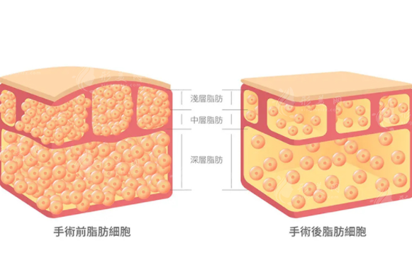 背部吸脂的常识有哪些？有风险和并发症吗？