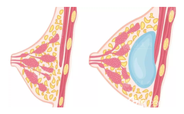 假体隆胸手术方法有哪些？乳晕切口好吗？