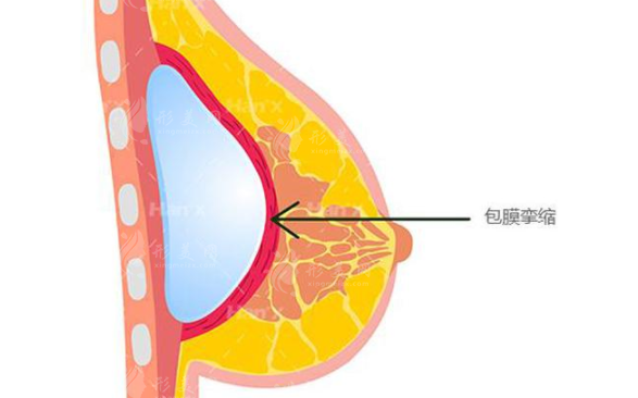 隆胸后包膜挛缩是什么症状？怎么解决呢？