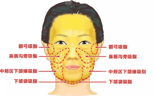 水动力面部吸脂效果好吗？一起来了解一下