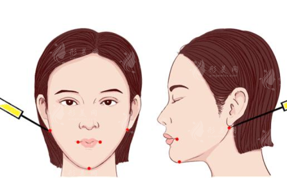 面部吸脂和去颊脂垫哪个好？该如何选择？