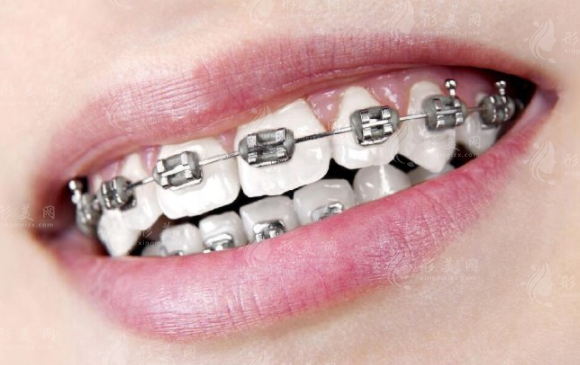 牙齿矫正会导致牙齿敏感和关节问题吗？