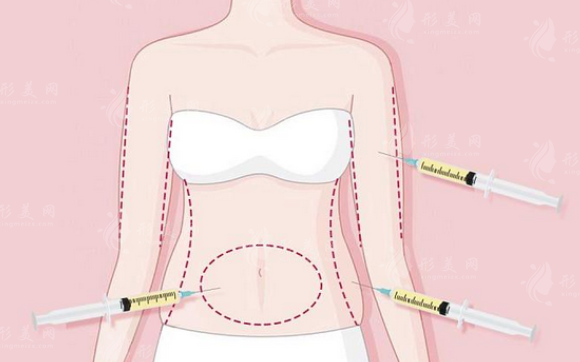 吸脂手术的抽取量是多少？塑身衣多长时间能看到效果？