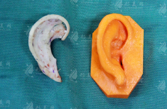 广州高尚整形医院做耳再造手术怎么样?余文林耳再造很有名