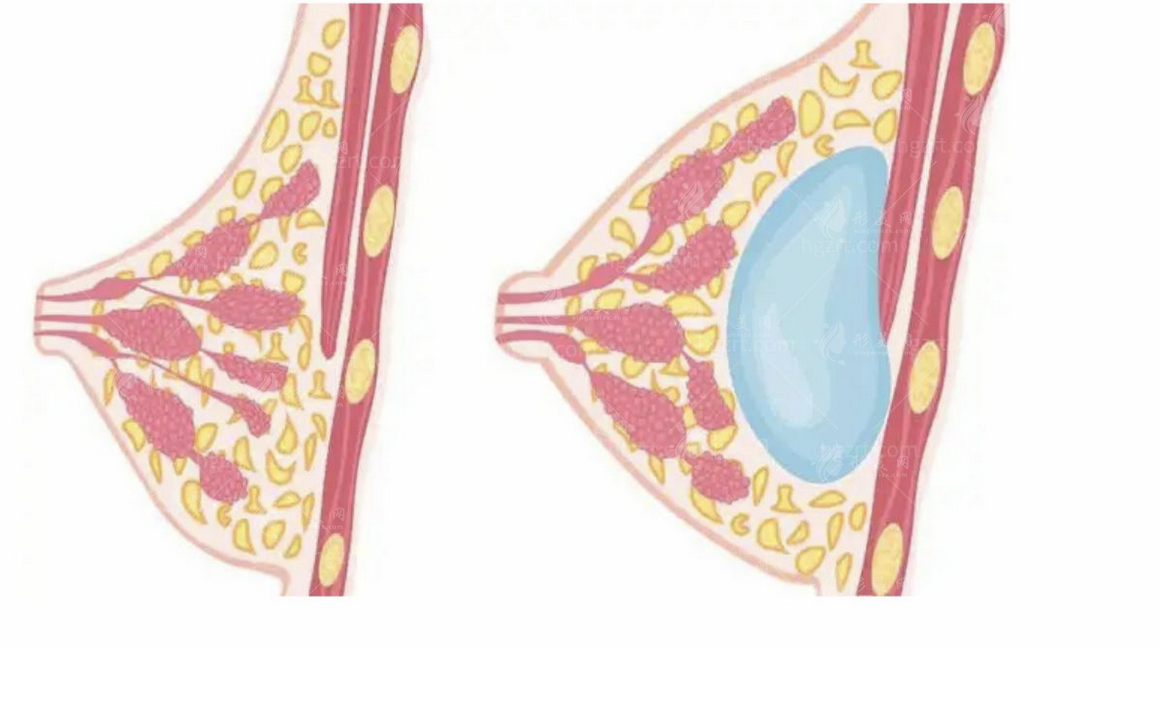 隆胸修复手术怎么样?有副作用吗?