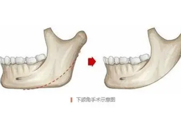 下颌角磨骨术恢复时间大概是多久？