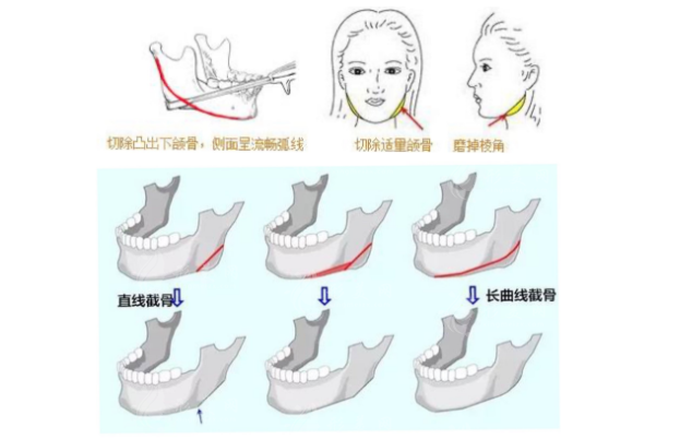 上海第九整形美容医院下颌角磨骨/正颌手术/颧骨内推手术价格