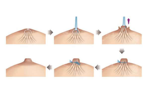 乳头内陷手术有必要做吗？