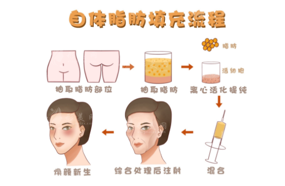 揭秘八大处李发成脂肪填充：精湛技艺与价格透明度解析