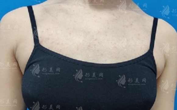 副乳切除术的优点与并发症分析