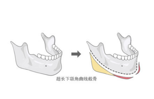 广东韩妃整形外科医院做颌面轮廓手术怎么样？